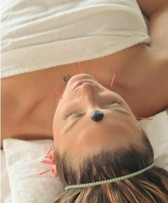 Acupuncture